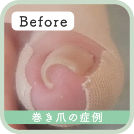 巻き爪の症例 Before